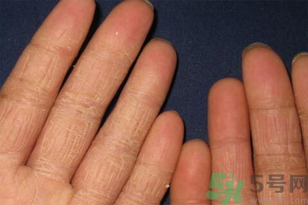 手足癬的治療方法？治療手足癬可以用什么藥？