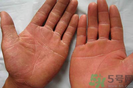 手足癬的治療方法？治療手足癬可以用什么藥？