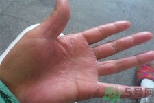 手足癬的易發(fā)人群有哪些？如何預(yù)防手足癬？