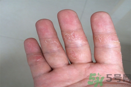 手足癬的易發(fā)人群有哪些？如何預(yù)防手足癬？