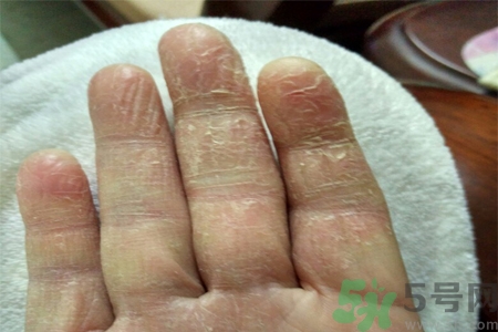 手足癬會傳染嗎？手足癬的傳播途徑有哪些？