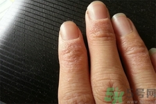 手足癬會傳染嗎？手足癬的傳播途徑有哪些？