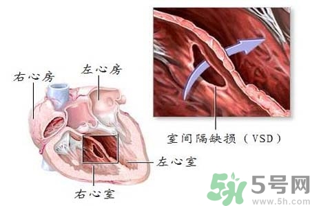 先天性心臟病是什么？先天性心臟病的癥狀有哪些？