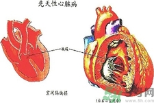 先天性心臟病發(fā)病原因是什么？