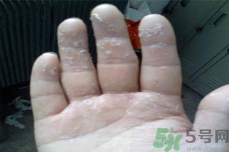 手足癬的易發(fā)人群有哪些？如何預(yù)防手足癬？