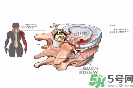 為什么年輕人容易得頸椎??？頸椎病嚴(yán)重的癥狀有哪些？