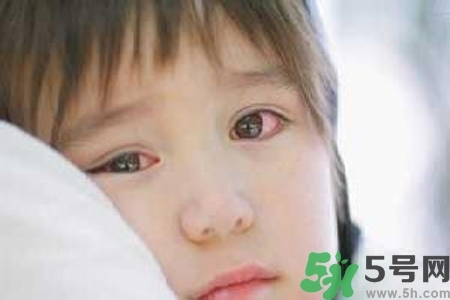 寶寶為什么會(huì)感染紅眼??？寶寶患紅眼病如何治療？