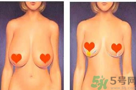 ?女性乳房下垂的原因是什么？女性乳房下垂的分類有哪些？