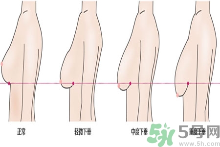 ?女性乳房下垂的原因是什么？女性乳房下垂的分類有哪些？