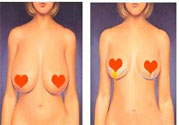 ?女性乳房下垂的原因是什么？女性乳房下垂的分類有哪些？