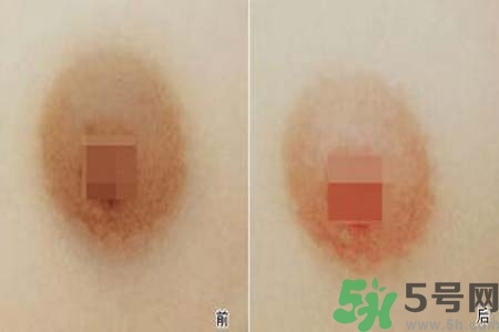 乳頭發(fā)黑怎么辦？怎么樣可以使乳頭變白？
