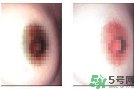 乳頭發(fā)黑怎么辦？怎么樣可以使乳頭變白？