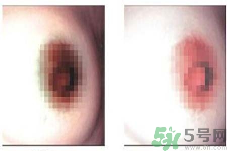 乳頭發(fā)黑是怎么回事？乳頭發(fā)黑是什么原因？
