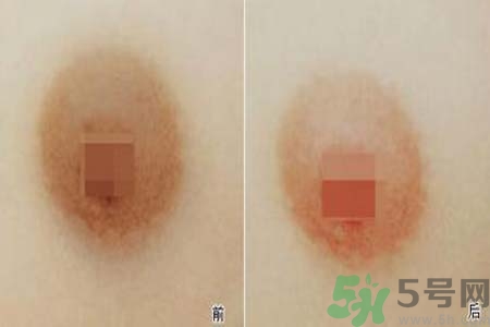 乳頭發(fā)黑是怎么回事？乳頭發(fā)黑是什么原因？