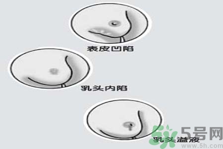 乳頭內陷怎么回事？乳頭內陷的原因是什么？