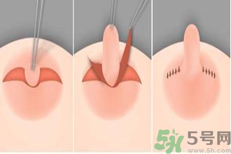 乳頭內陷怎么回事？乳頭內陷的原因是什么？