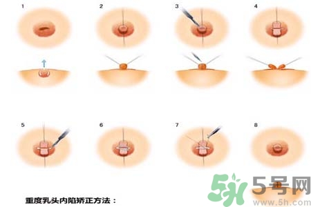 乳頭內陷怎么回事？乳頭內陷的原因是什么？