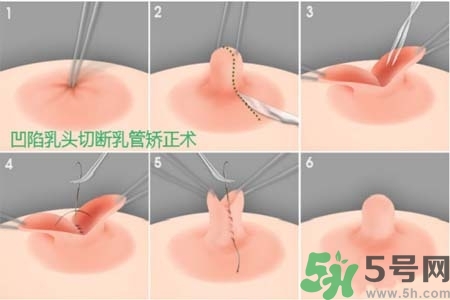 乳頭內(nèi)陷怎么辦？乳頭內(nèi)陷的癥狀有哪些？