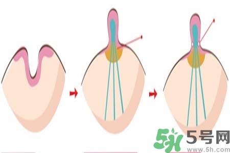 乳頭內(nèi)陷怎么辦？乳頭內(nèi)陷的癥狀有哪些？