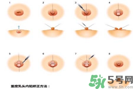 乳頭內(nèi)陷怎么辦？乳頭內(nèi)陷的癥狀有哪些？