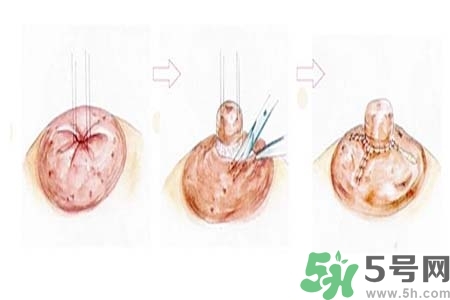 乳頭內(nèi)陷怎么辦？乳頭內(nèi)陷的癥狀有哪些？