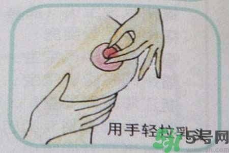 乳頭內(nèi)陷怎么辦？乳頭內(nèi)陷的癥狀有哪些？