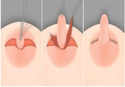 乳頭內(nèi)陷怎么辦？乳頭內(nèi)陷的癥狀有哪些？