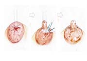 乳頭內(nèi)陷矯正需注意什么？乳頭內(nèi)陷如何預(yù)防？