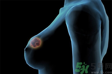 乳房屋硬塊有疼痛感怎么回事？乳房屋硬塊有疼痛感怎么辦？