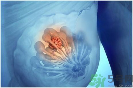 乳房屋硬塊有疼痛感怎么回事？乳房屋硬塊有疼痛感怎么辦？