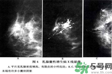 產(chǎn)生乳腺增生鈣化的病因是什么？乳腺增生怎樣治療？