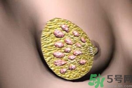 乳腺增生鈣化是什么？乳腺鈣化的癥狀有哪些？