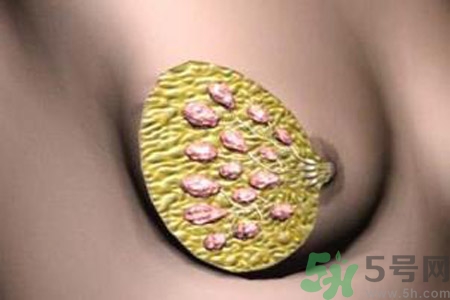 產(chǎn)生乳腺增生鈣化的病因是什么？乳腺增生怎樣治療？