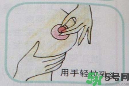 乳頭內(nèi)陷怎么矯正？乳頭內(nèi)陷矯正方法是什么？