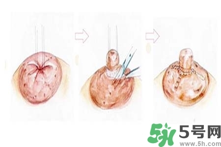 乳頭內(nèi)陷怎么矯正？乳頭內(nèi)陷矯正方法是什么？