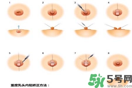乳頭內(nèi)陷怎么矯正？乳頭內(nèi)陷矯正方法是什么？