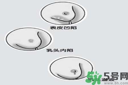 乳頭內(nèi)陷怎么矯正？乳頭內(nèi)陷矯正方法是什么？