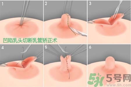 乳頭內(nèi)陷怎么矯正？乳頭內(nèi)陷矯正方法是什么？