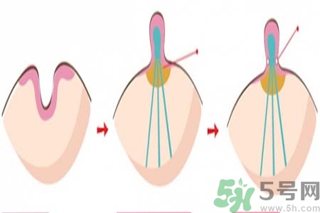乳頭內陷矯正需注意什么？乳頭內陷如何預防？