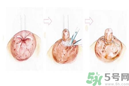 乳頭內陷矯正需注意什么？乳頭內陷如何預防？
