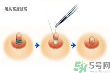 乳頭內(nèi)陷能不能喂奶？乳頭凹陷怎樣哺乳？
