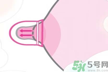 乳頭內(nèi)陷可以拔罐嗎？乳頭內(nèi)陷需要手術(shù)治療嗎？