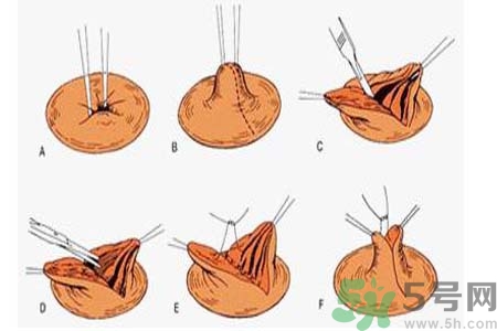乳頭內(nèi)陷可以拔罐嗎？乳頭內(nèi)陷需要手術(shù)治療嗎？