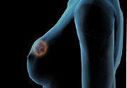 哺乳期乳房有硬塊疼痛怎么辦？如何預(yù)防哺乳期乳房有硬塊？