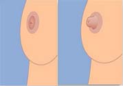 乳頭內(nèi)陷可以用吸奶器嗎？乳頭內(nèi)陷能不能用吸奶器？