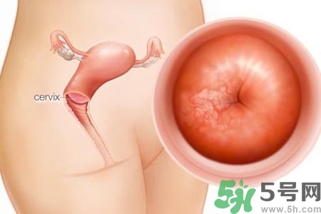 陰道出血和什么有關(guān)？陰道出血的應(yīng)急措施有哪些？