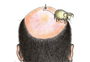禿頂會遺傳嗎？治療禿頂?shù)姆椒ㄊ鞘裁矗?><p><strong>禿頂會遺傳嗎？治療禿頂?shù)姆椒ㄊ鞘裁矗?/strong></p></a></li> </ul>
</div>
<div   id=