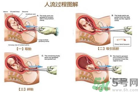 人工流產(chǎn)后多久可以再次懷孕？流產(chǎn)后需要注意什么？