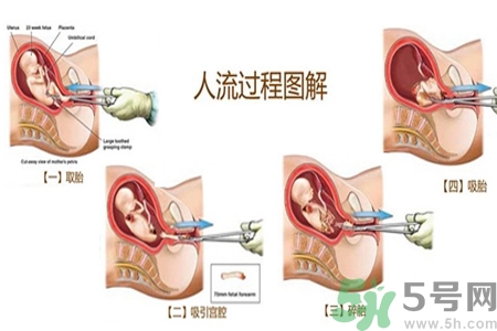 人工流產(chǎn)后多久可以再次懷孕？流產(chǎn)后需要注意什么？