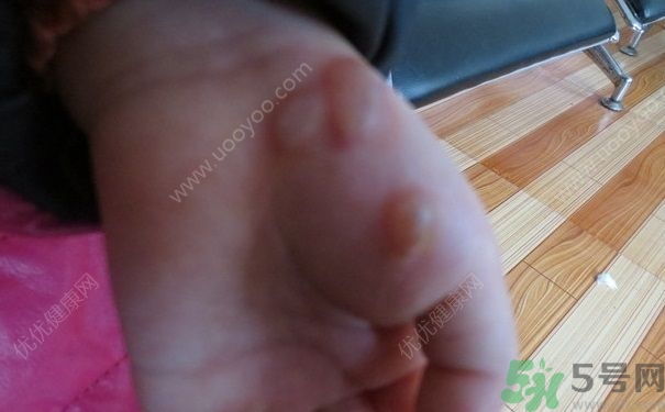 15歲還會(huì)得手足口病嗎？手足口病的癥狀有哪些？